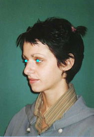 Chirurgia Estetica - Rinoplastica - foto prima dopo.